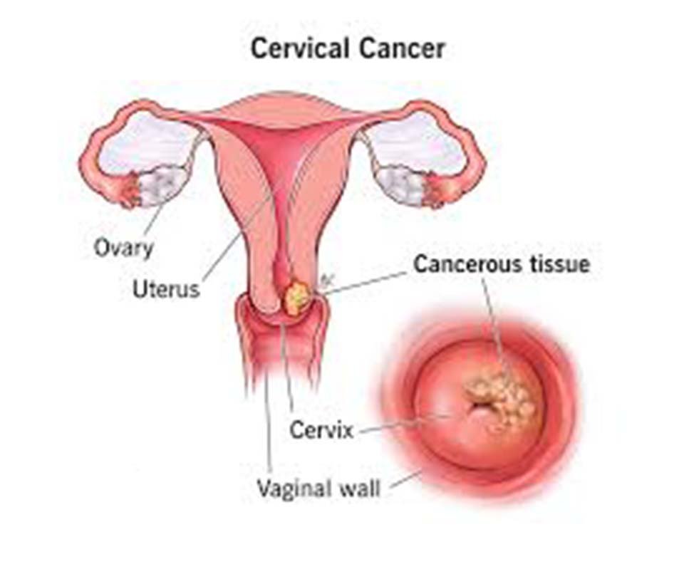 Cervical Cancer