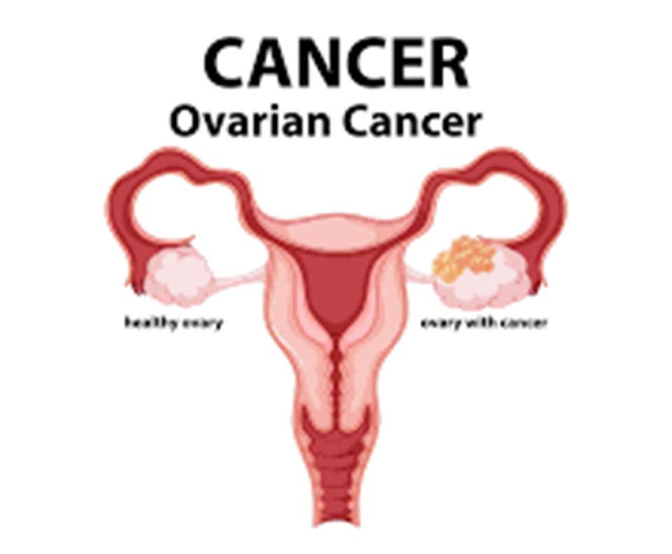 Ovarian Cancer