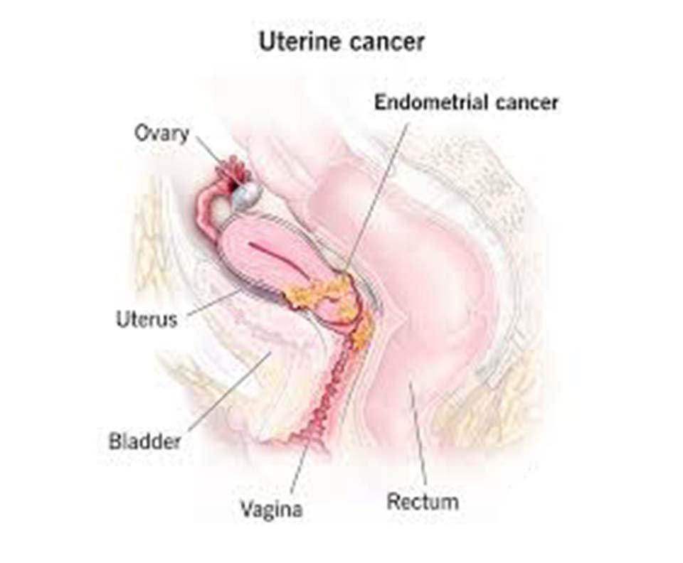 Uterine Cancer