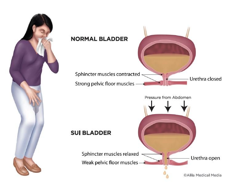 SUI (Stress Urinary Incontinence)