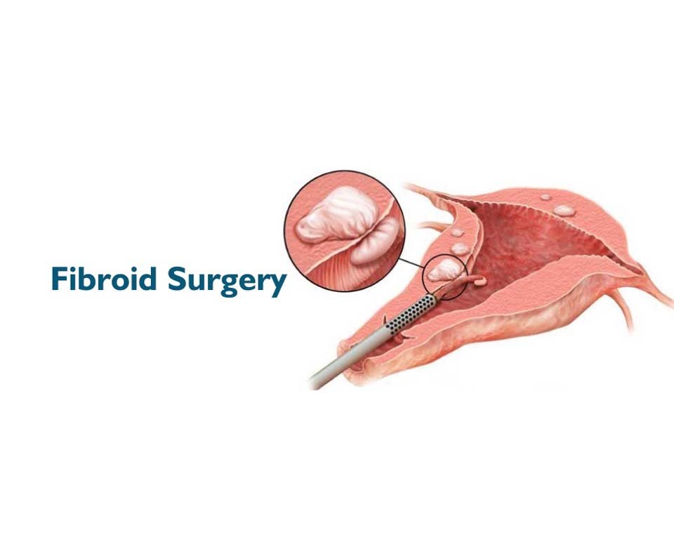 Fibroid Surgery