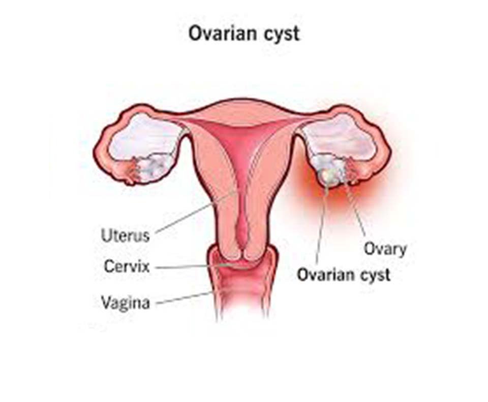 Ovarian Cysts