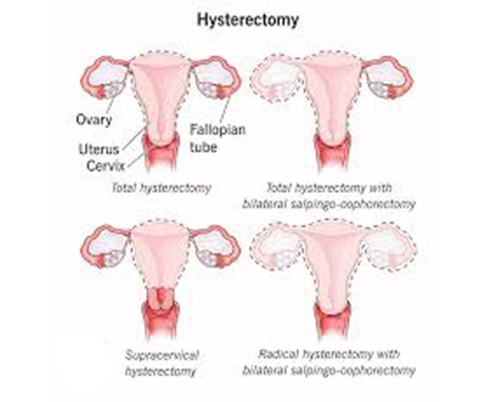 Hysterectomy