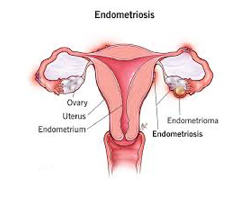 Endometriosis