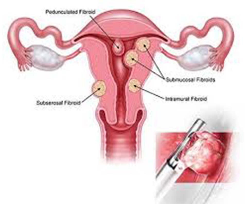 Polypectomy Surgery