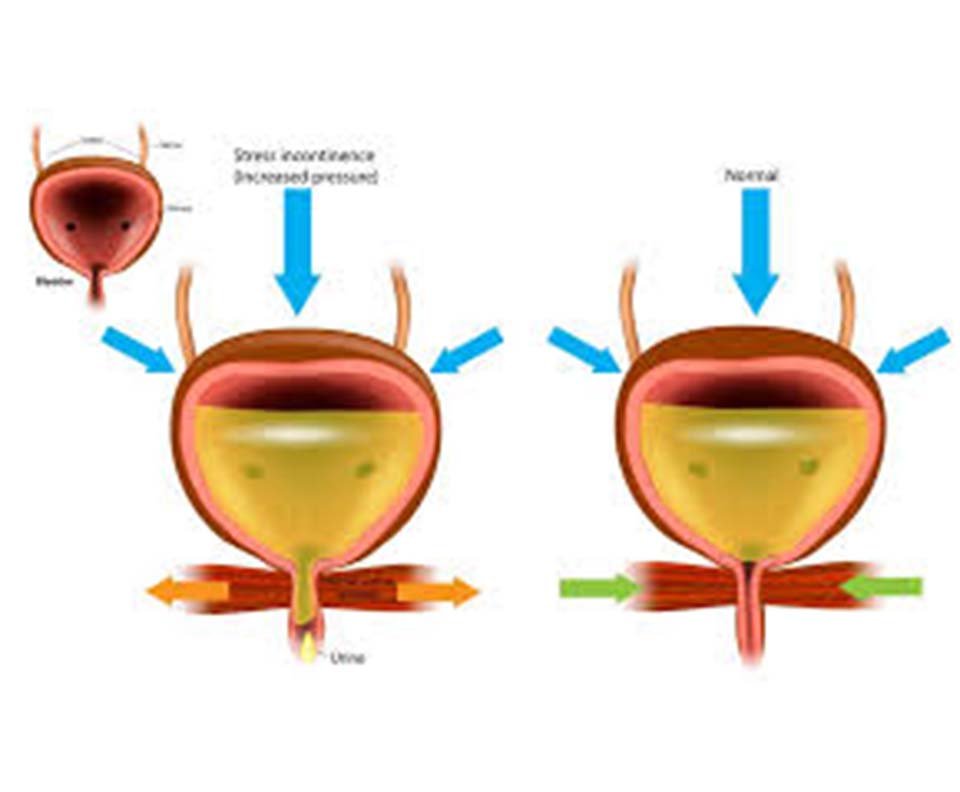 SUI (Stress Urinary Incontinence)